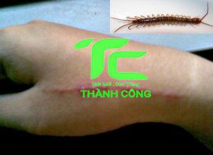 Cẩm nang: Cách trị bệnh giời leo và phương pháp diệt con giời leo hiệu quả, đơn giản 6 4 1