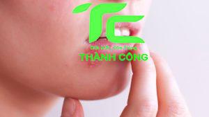 Bị kiến cắn sưng môi phải làm sao? Cách khắc phục hiệu quả 8 Bị kiến cắn sưng môi phải làm sao? Cách khắc phục hiệu quả