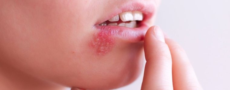 Bị kiến cắn sưng môi phải làm sao? Cách khắc phục hiệu quả